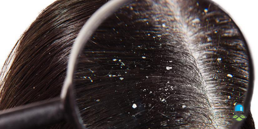 چه زمانی شوره سر دیگر یک مشکل ساده نیست؟